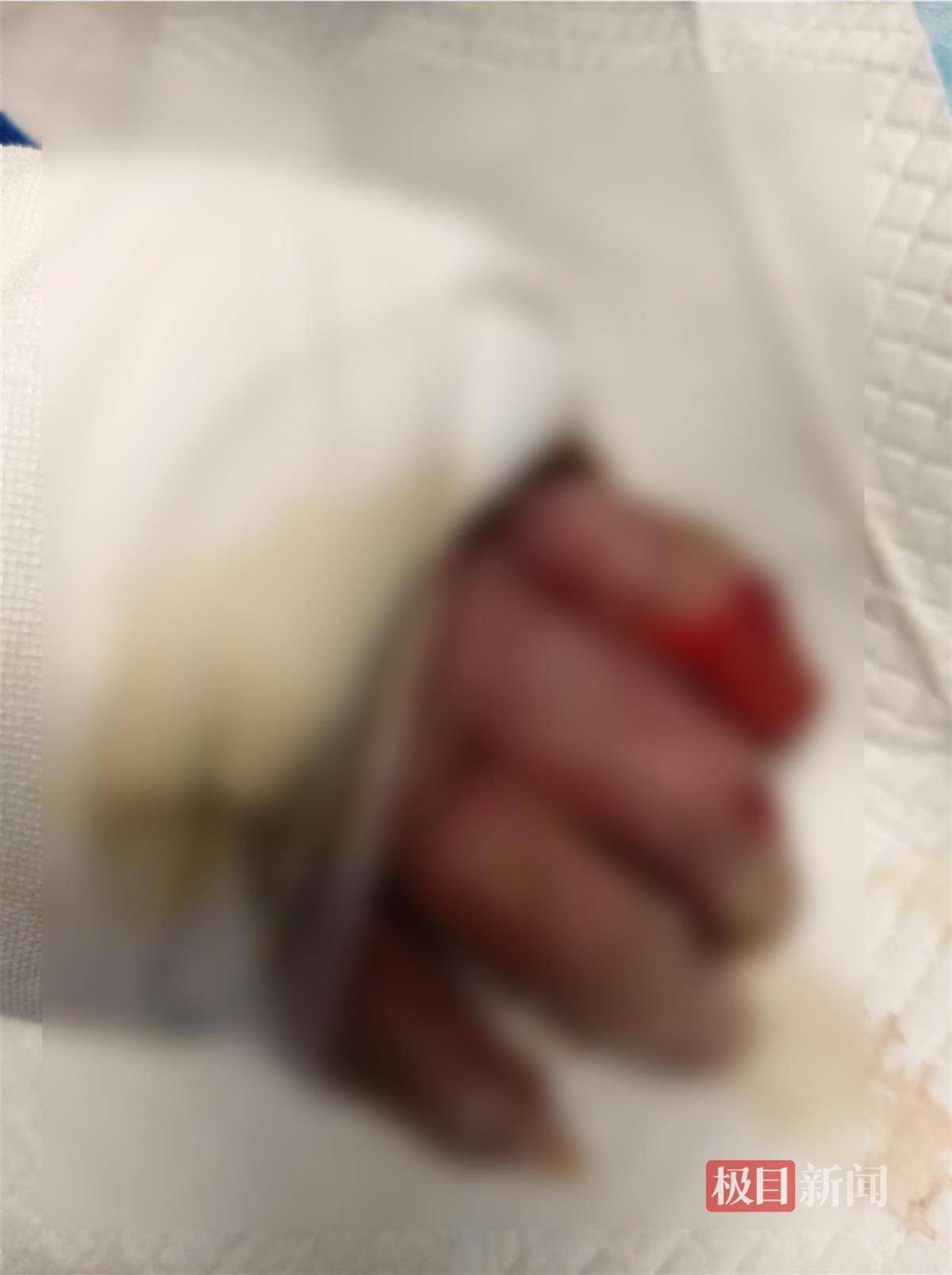 皇冠信用盘怎么开户
_男子帮邻居关液化气瓶遭遇爆炸皇冠信用盘怎么开户
，严重烧伤4个月后不幸离世，家属：治伤花了近140万，将为他申请见义勇为