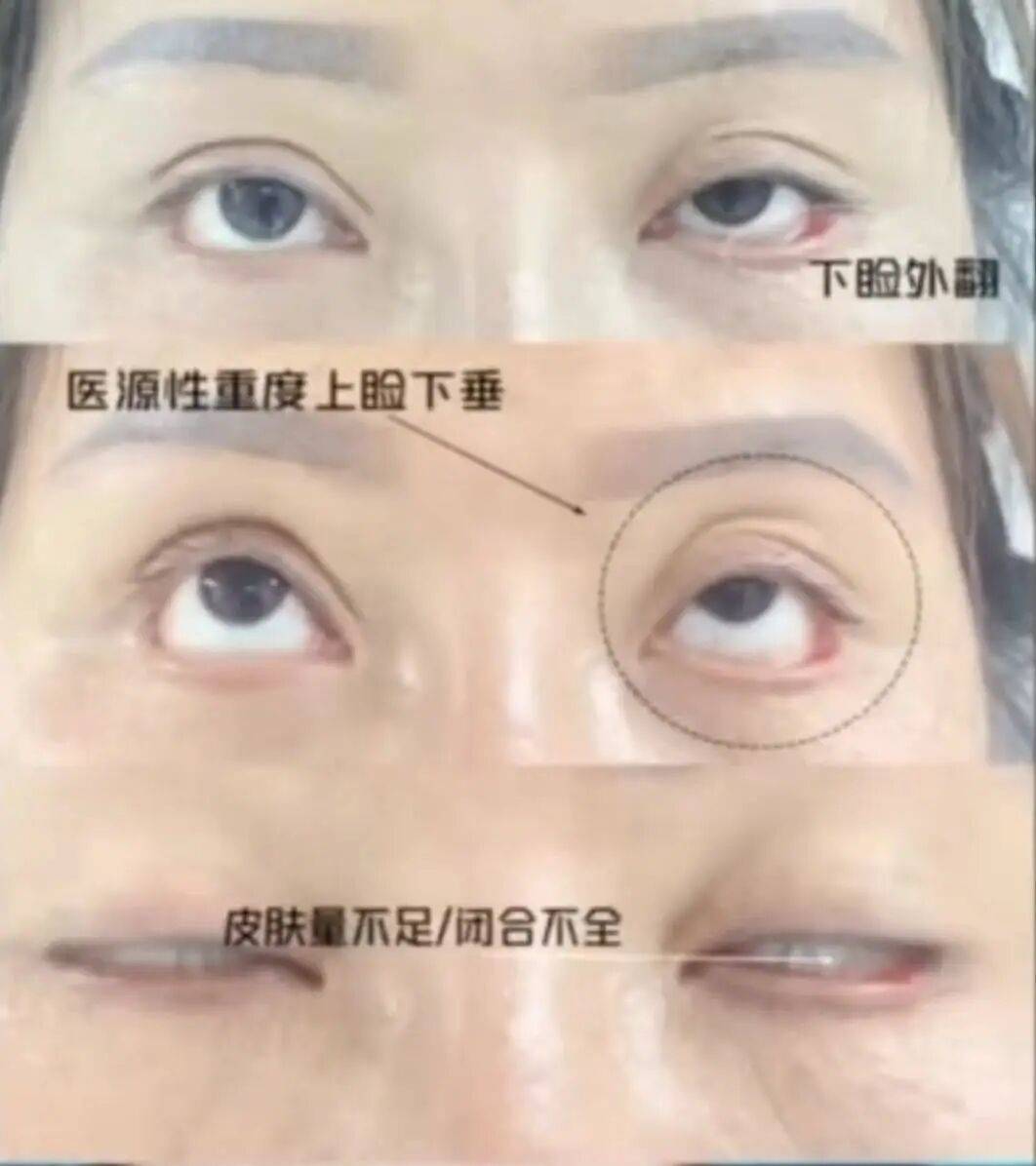 皇冠开户网址_“睡觉都是睁着眼” 皇冠开户网址，女子受老乡邀约，割双眼皮后无法闭眼，落下9级伤残，整形机构老板获刑后反起诉，女子被判退还20万元
